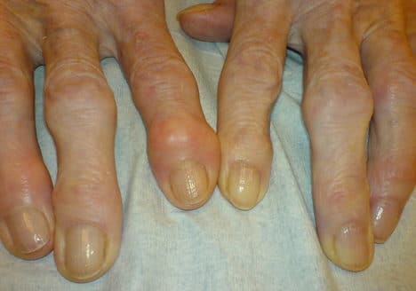 Sufres Artrosis? causas, síntomas y tratamiento