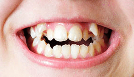deformación dientes