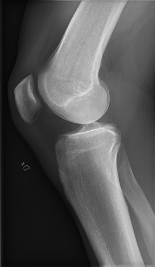 ligamento cruzado anterior rx de rodilla
