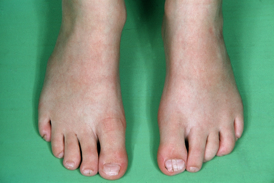 patología de uñas de los pies