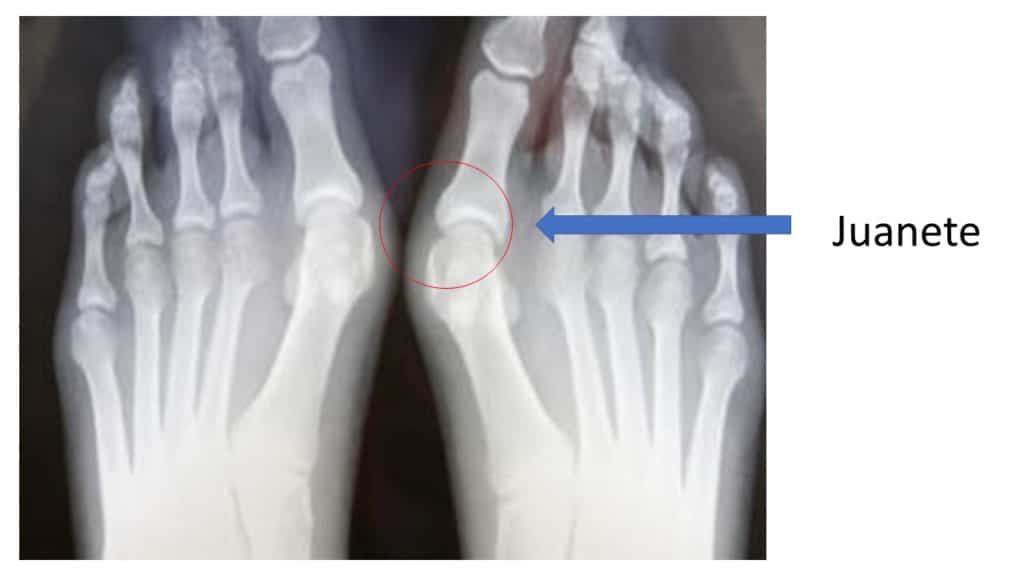 Neuroma de Morton Juanete