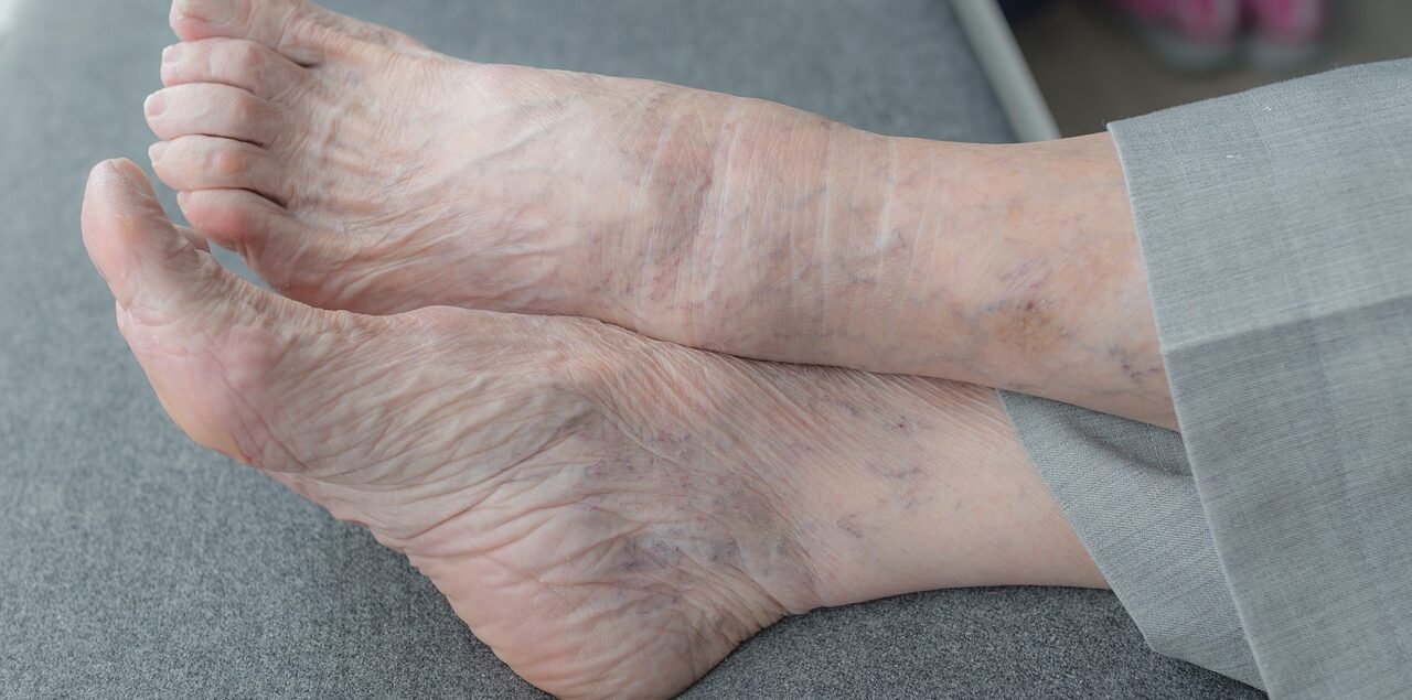 Juanetes o Hallux Valgus por Clínica Fuensalud