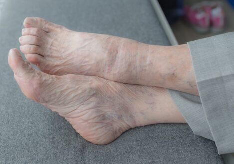 Juanetes o Hallux Valgus por Clínica Fuensalud