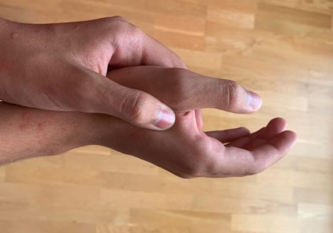 Qué es la Tendinitis de Quervain