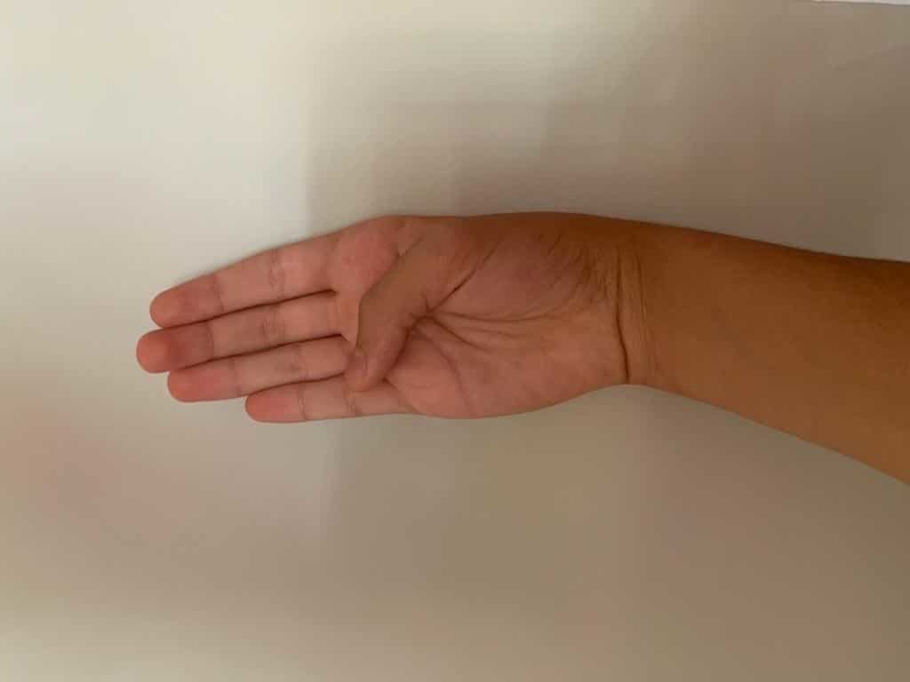Test de Finkelstein 1 Clínica Fuensalud Quervain