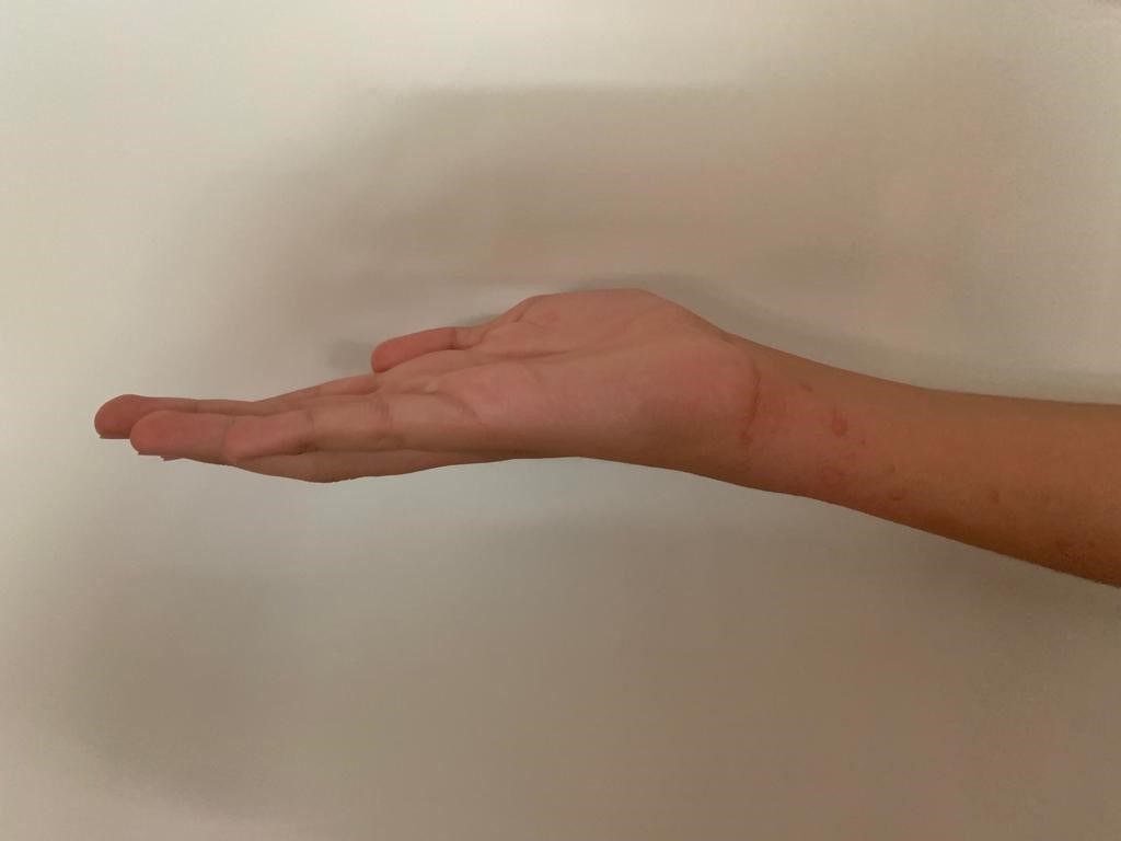 ejercicio 3 Clínica Fuensalud Quervain