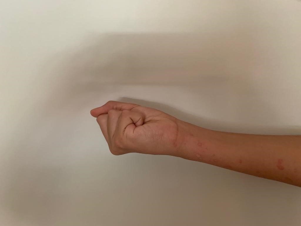 ejercicio3-1 Clínica Fuensalud Quervain