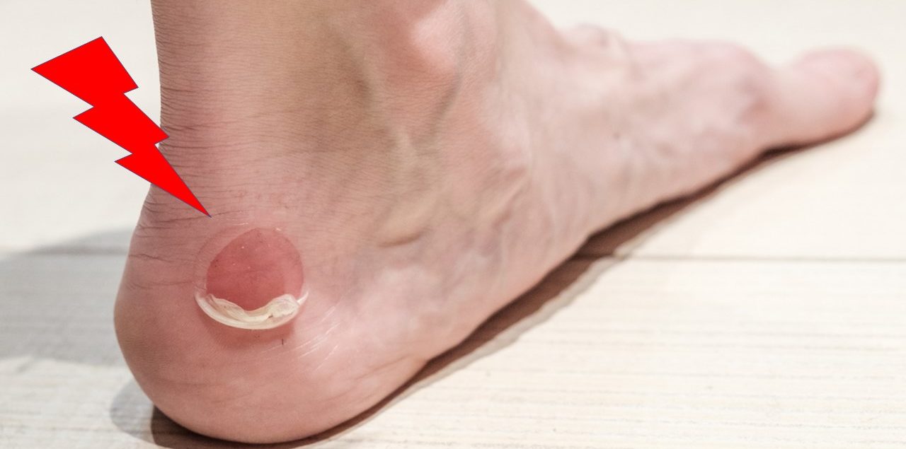 Ampollas ¿cómo y prevenirlas? - Clínica Fuensalud