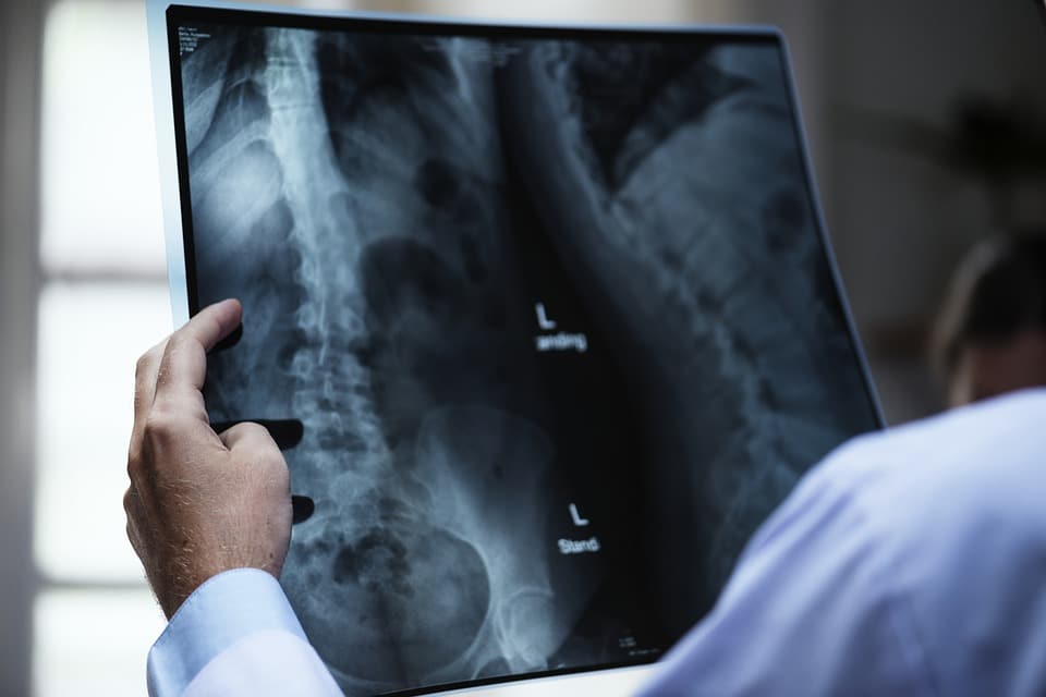 Radiografía hernia discal