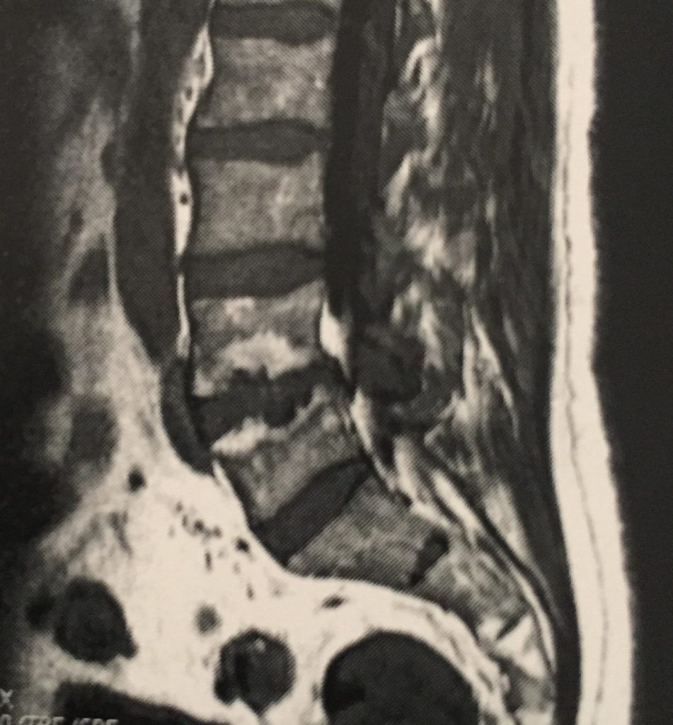 Rm de columna herniada o con hernia discal