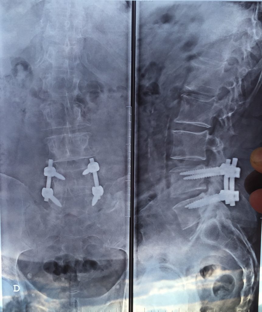 Rx de columna operada Hernia Discal