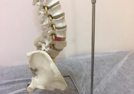 HERNIA DISCAL QUÉ PUEDO HACER
