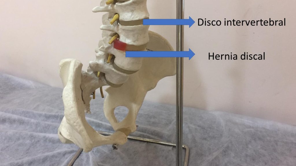 hernia discal punto rojo