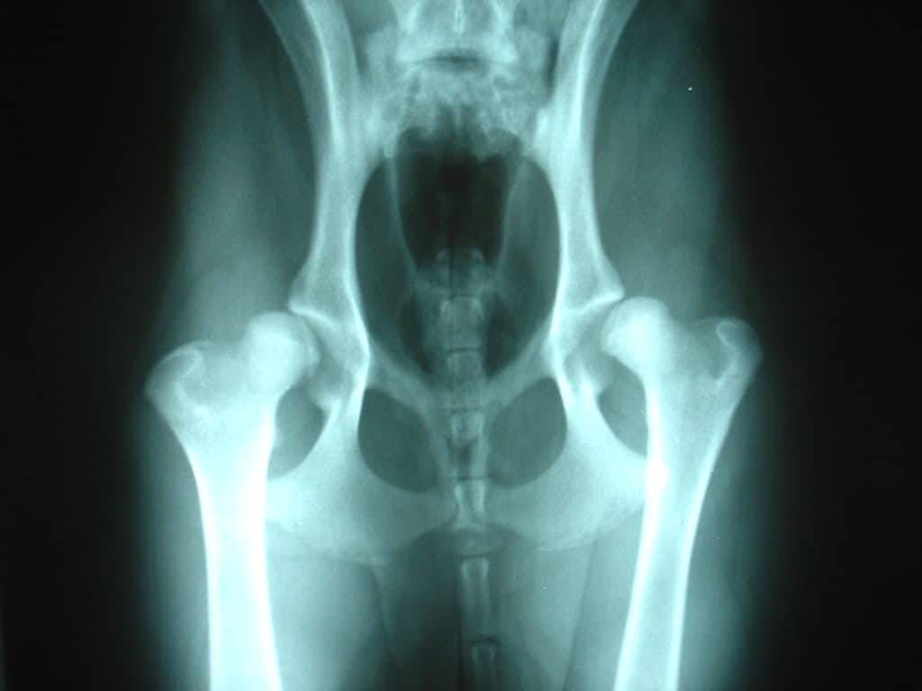 Rx de artrosis de cadera