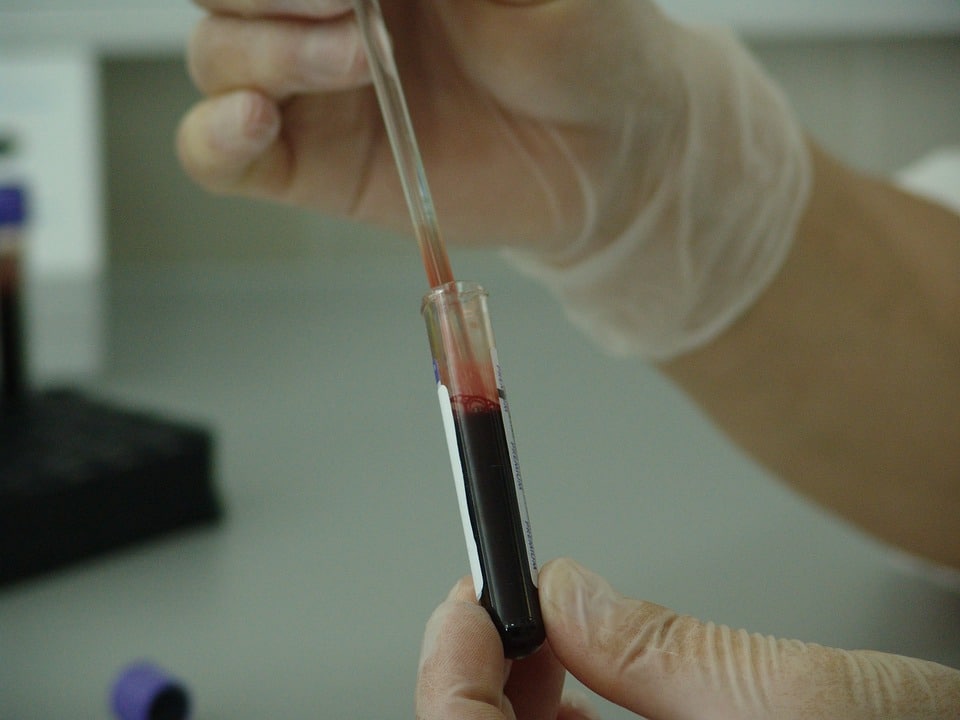 análisis de sangre para LUPUS