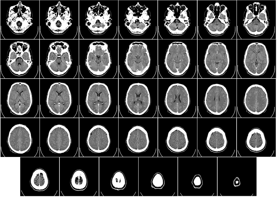 resonancia magnética esclerosis múltiple