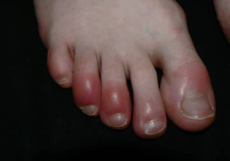 5 Consejos para quitar los Sabañones Clínica fuensalud