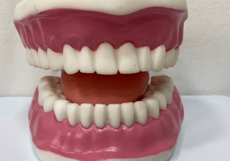 Bruxismo : causas, síntomas y tratamiento