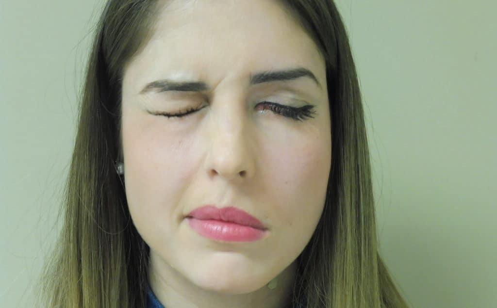 Parálisis facial tratada con Acupuntura por Clínica Fuensalud