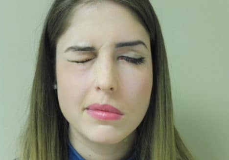 Parálisis facial tratada con Acupuntura por Clínica Fuensalud