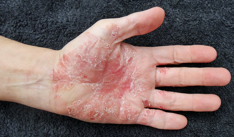 Psoriasis localizadas por Clínica Fuensalud