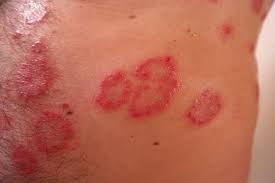 Psoriasis por Clínica Fuensalud