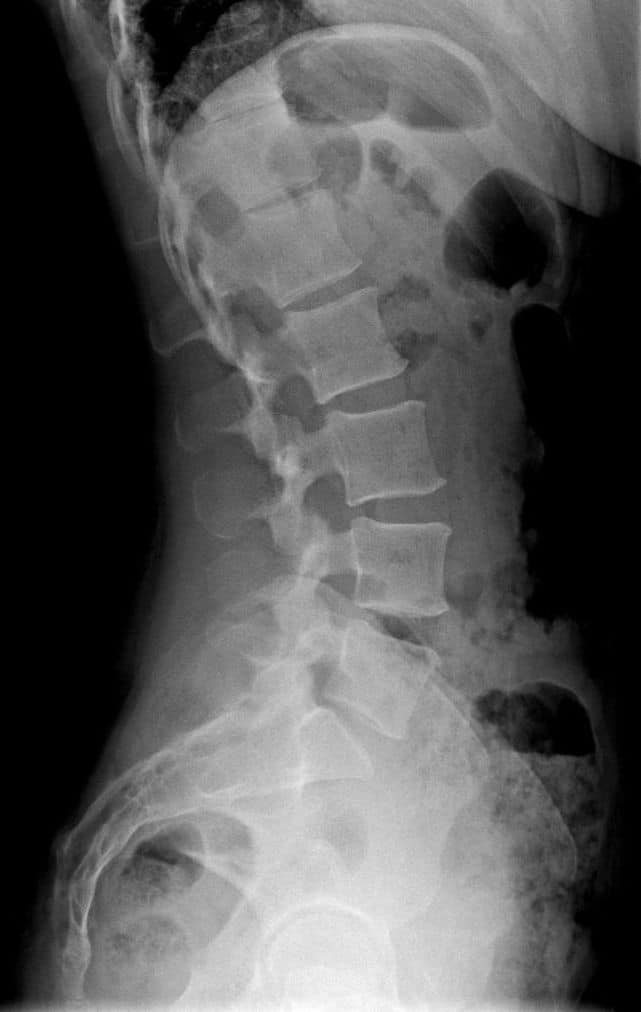 Radiografía de la columna vertebral para detectar trocanteritis por Clínica Fuensalud