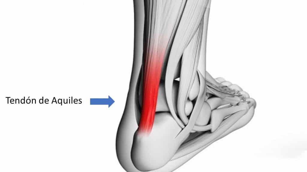 Tendón de Aquiles por Clínica Fuensalud