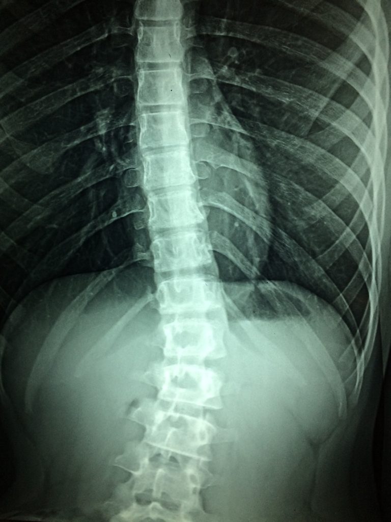 Radiografía de Columna Vertebral por Clínica Fuensalud