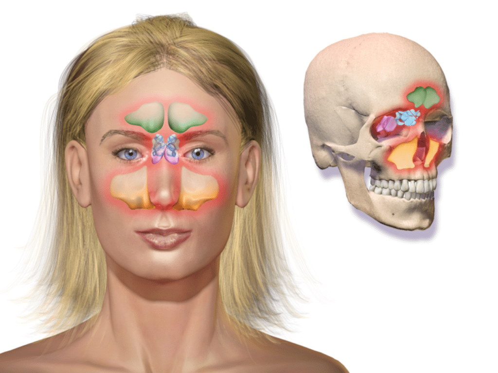 Sinusitis por Clínica Fuensalud