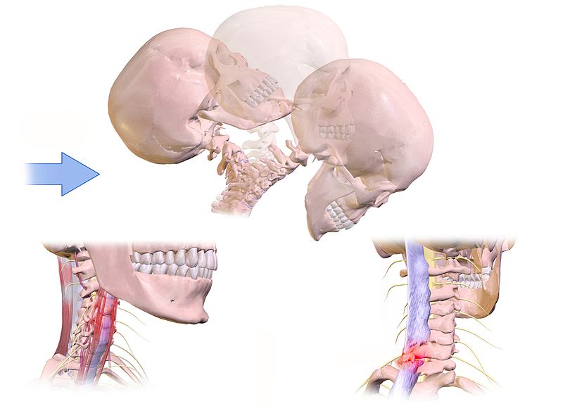 Latigazo Cervical por Clínica Fuensalud