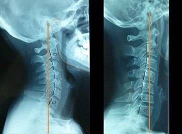 Radiografía de cuello por Clínica Fuensalud