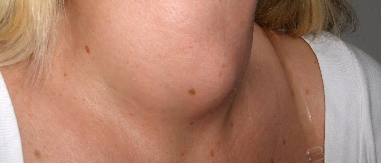 Tratamiento de Hipotiroidismo con acupuntura por Clínica Fuensalud