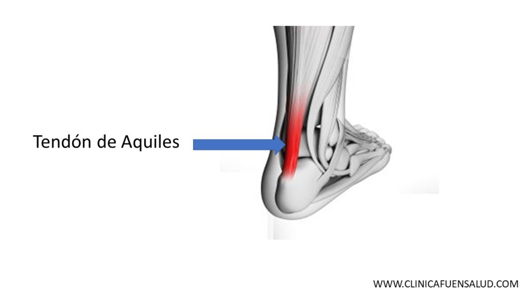 Tendinitis del Tendón de Aquiles por Clínica Fuensalud