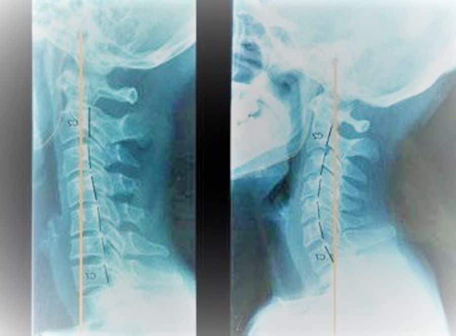 Radiografía de cervicales por Clínica Fuensalud