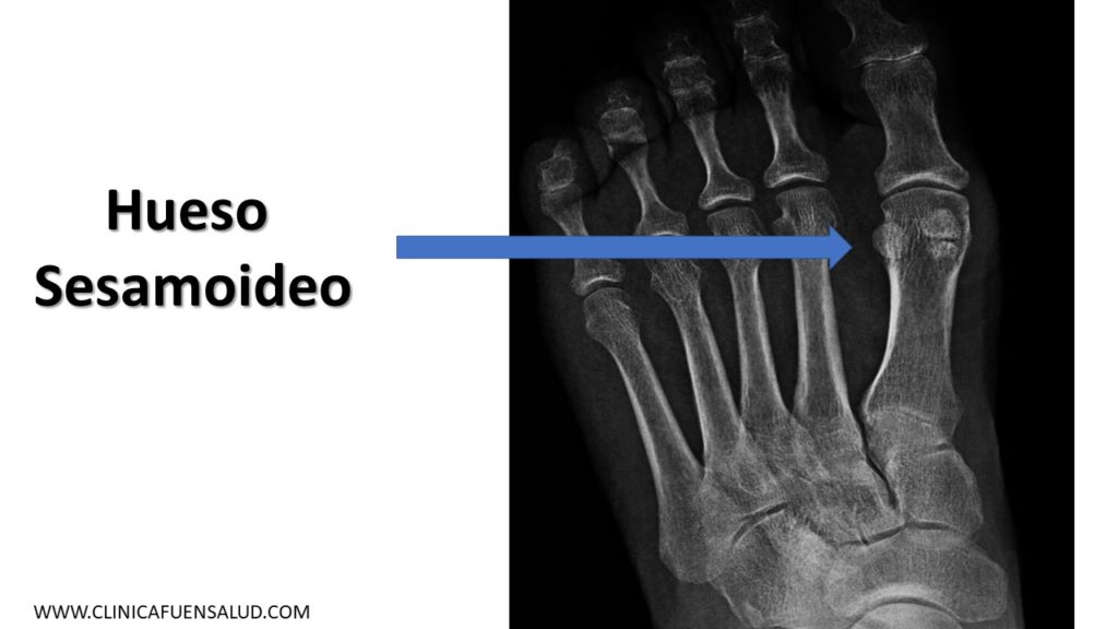 Anatomía del pie  hueso sesamoideo por Clínica Fuensalud