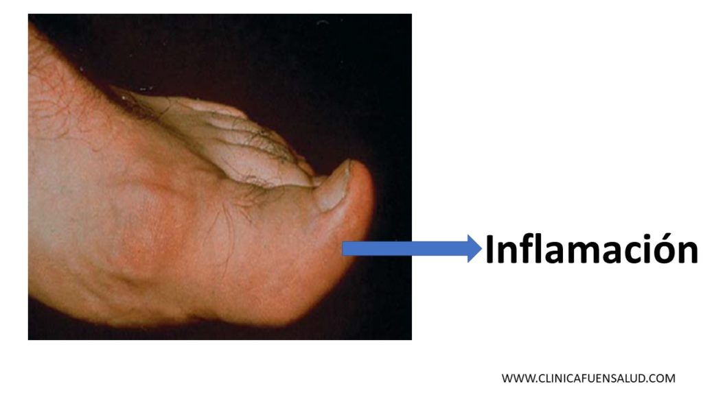 Inflamación Sesamoiditis  por Clínica Fuensalud