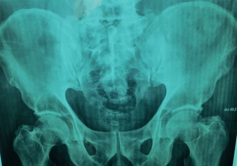 Prótesis de cadera por Clínica Fuensalud