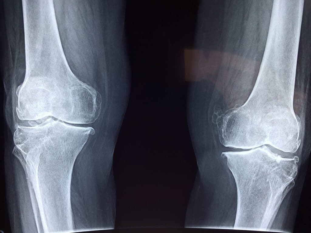 Artrosis de rodilla por Clínica Fuensalud
