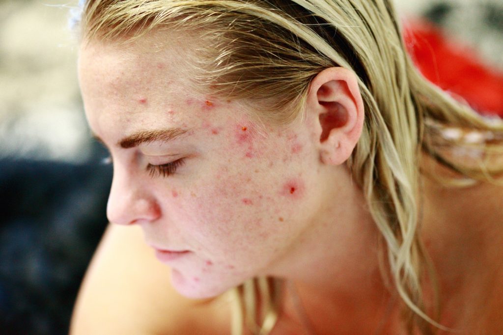 síndrome del quemado da Problemas en la piel