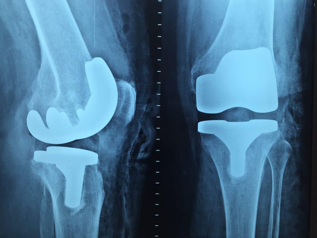 Dos Prótesis de rodilla con Clínica Fuensalud