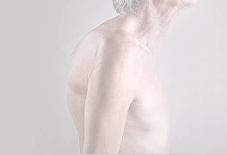 Cifosis-joroba-chepa Clínica Fuensalud