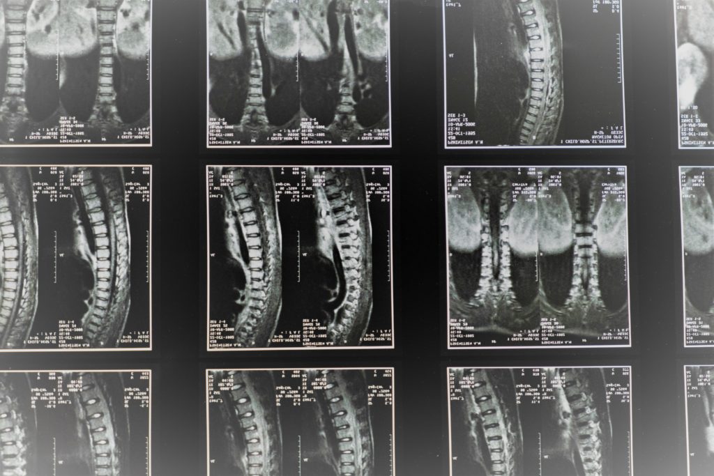 RMN de columna de Clínica Fuensalud