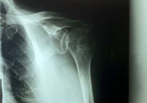Fractura de hombro de Clínica Fuensalud