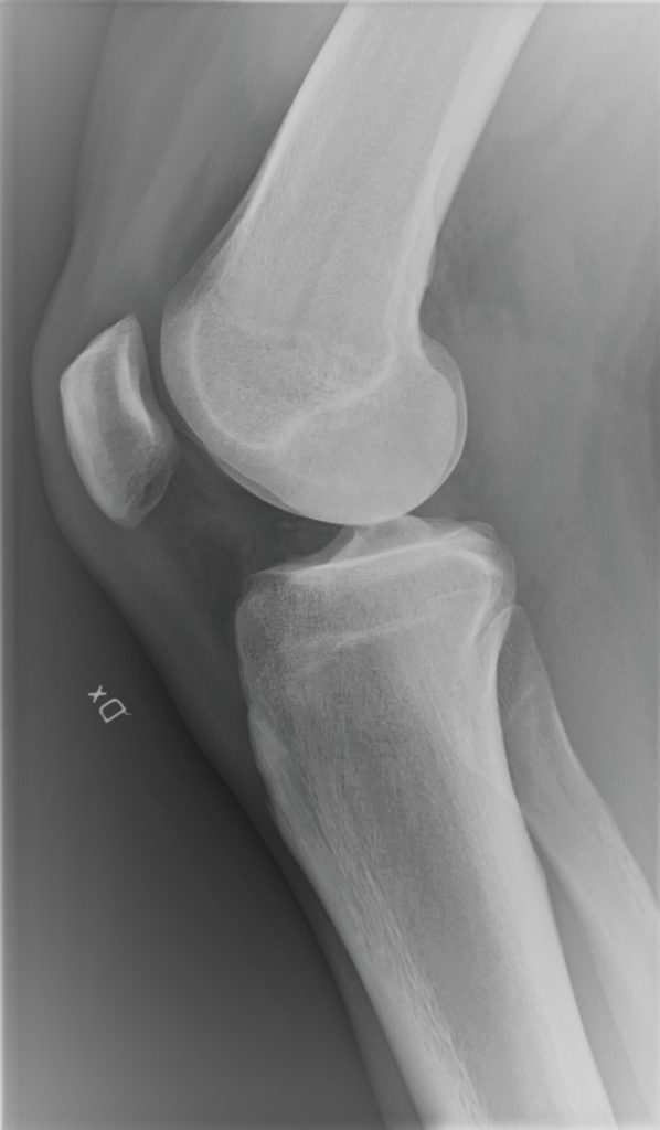 Rx de rodilla con Clínica Fuensalud