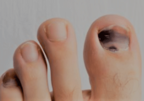 uñas negras tratadas por logopeda en por Clínica Fuensalud