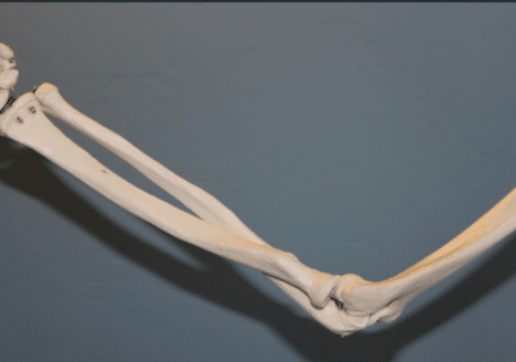 Fractura de codo por Clínica Fuensalud