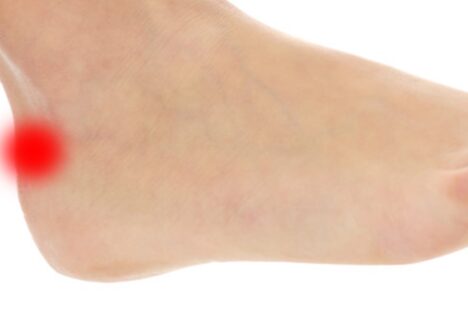 Enfermedad de Haglund por Clínica Fuensalud