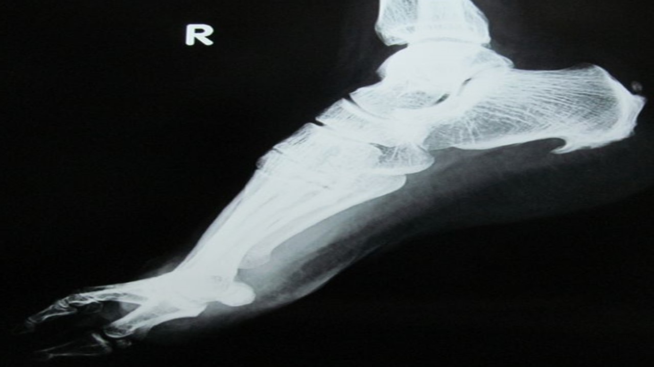 Espolón calcáneo tratado con podología - Clínica Fuensalud