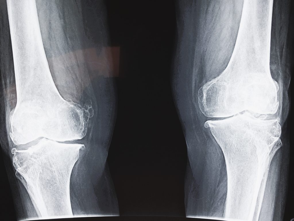 Radiografía (Rx) de artrosis de rodilla por Clínica Fuensalud